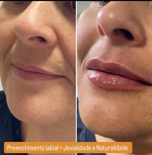 Preenchimento Labial